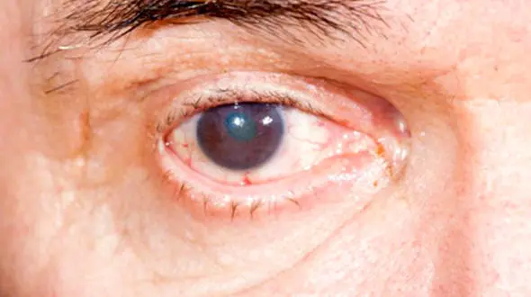 نشانه های هشداردهنده ابتلا به آب مروارید چشم