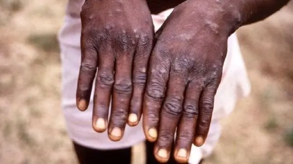 افزایش مبتلایان به آبله میمون در عربستان