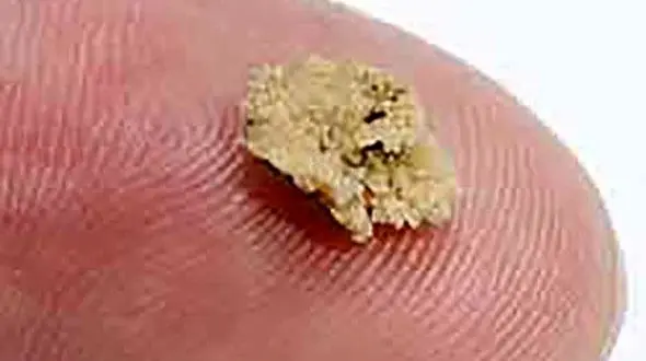 این روغن را بمالید سنگ کلیه دفع می شود! + جزییات