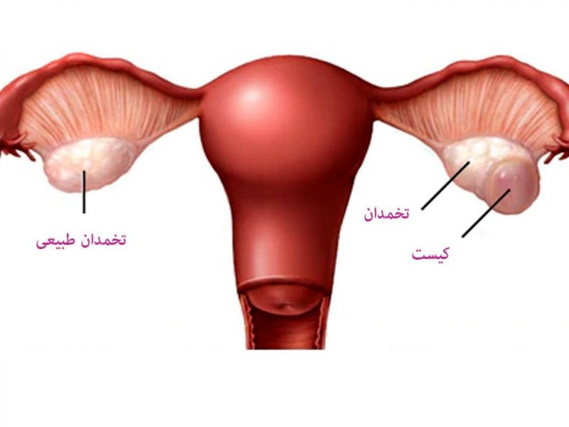 کیست تخمدان