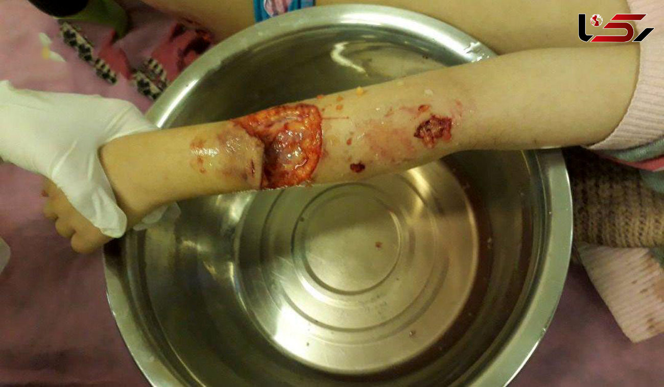 حمله خونین سگ ولگرد به کودک کرجی / یک محکومیت عجیب + جزییات