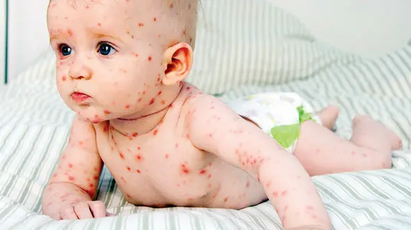ویروس سنجاقک روی پوست نوزاد