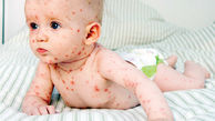 ویروس سنجاقک روی پوست نوزاد