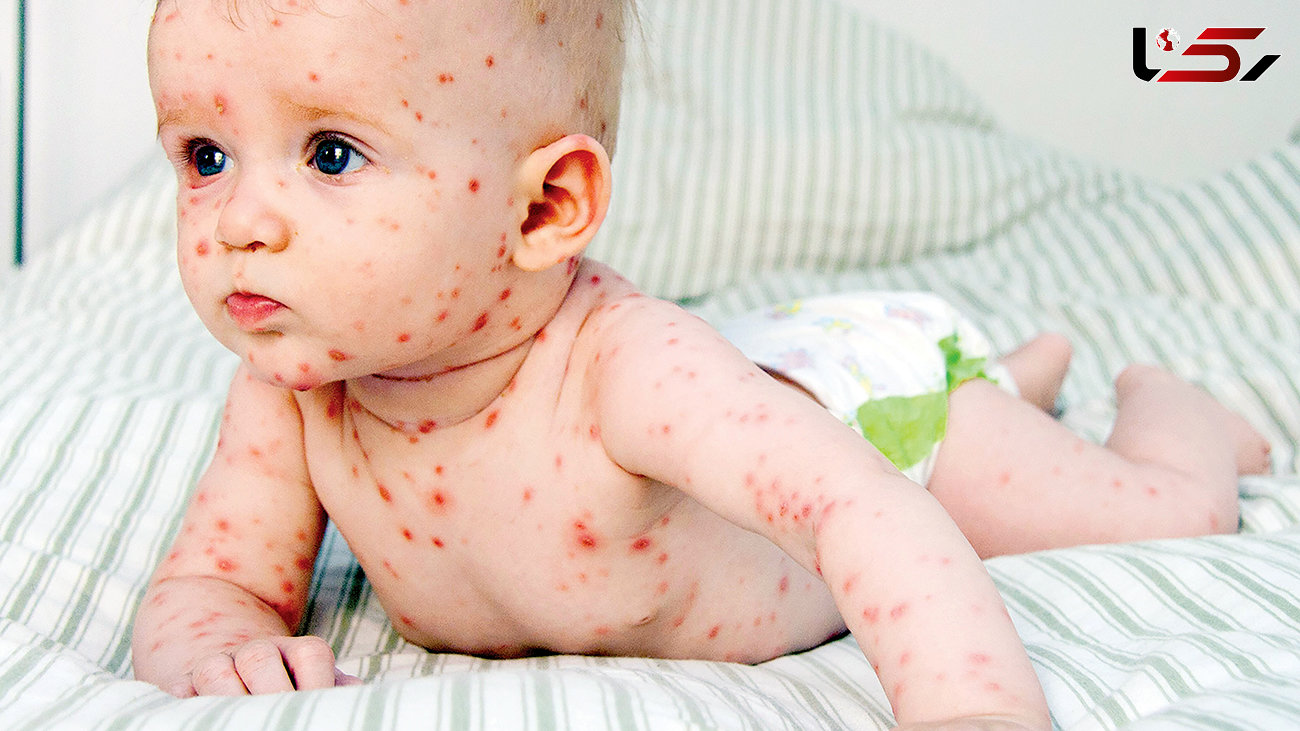 ویروس سنجاقک روی پوست نوزاد
