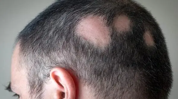 
راهکار طب‌سنتی برای ریزش موی سکه‌ای +علل ابتلا به آلوپسی آره آتا
