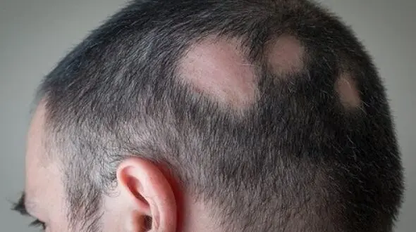 
راهکار طب‌سنتی برای ریزش موی سکه‌ای +علل ابتلا به آلوپسی آره آتا
