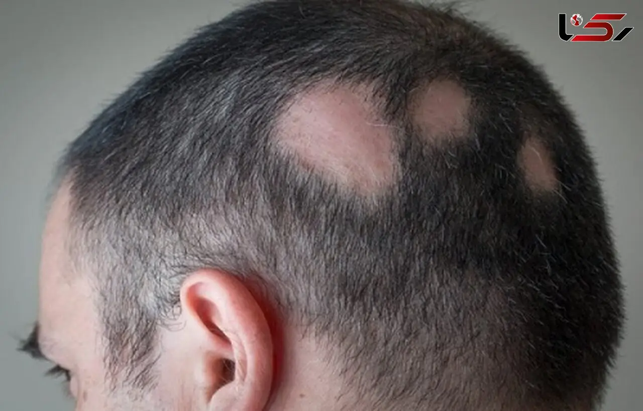 
راهکار طب‌سنتی برای ریزش موی سکه‌ای +علل ابتلا به آلوپسی آره آتا
