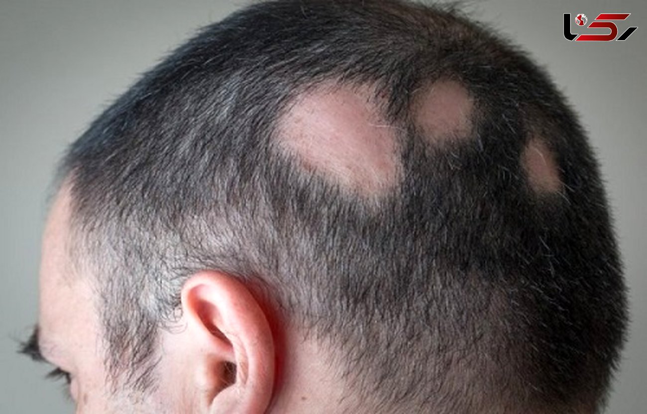 
راهکار طب‌سنتی برای ریزش موی سکه‌ای +علل ابتلا به آلوپسی آره آتا
