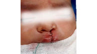 جراحی لب شکافته کودک 4 ماهه در سراوان + عکس تکاندهنده