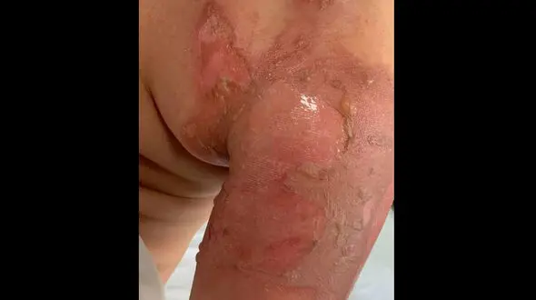 سوختن وحشتناک پسر جوان بخاطر یک چالش! + عکس 16+