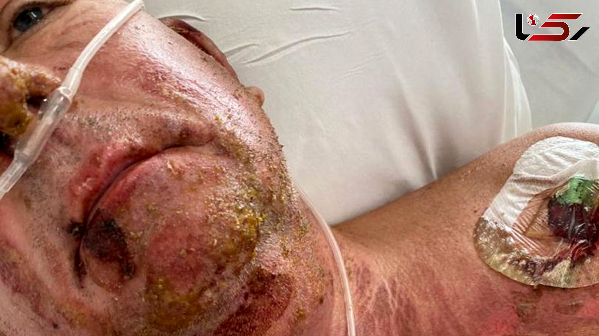 Dad suffers horror injuries after setting himself on fire in freak gardening accident