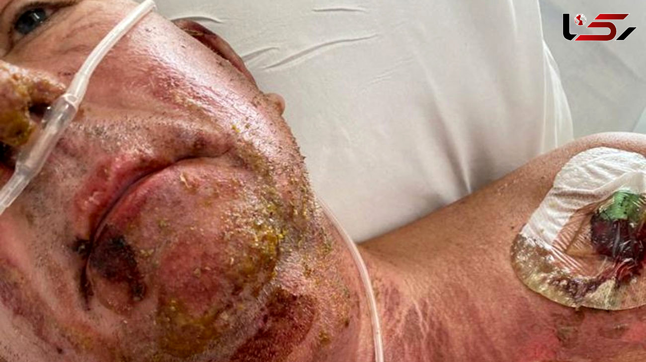 Dad suffers horror injuries after setting himself on fire in freak gardening accident