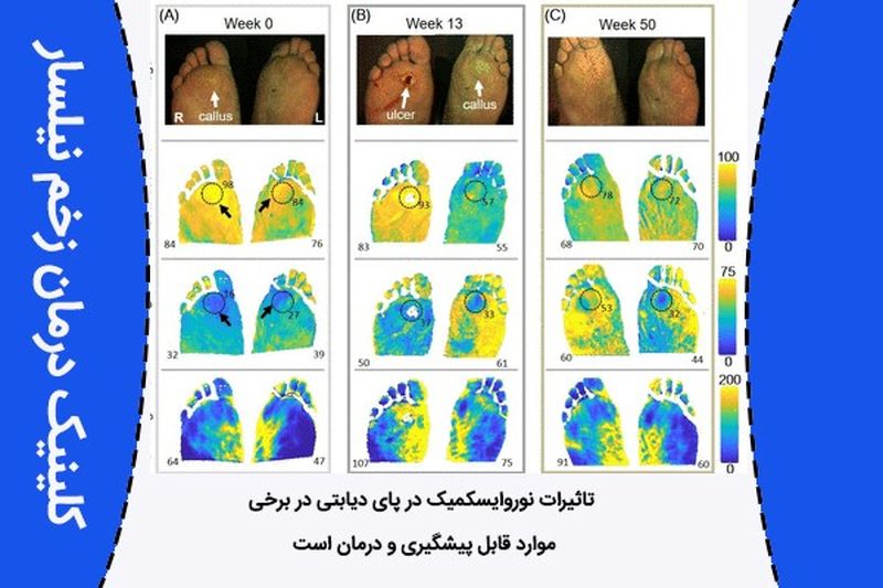 دیابتی قابل پیشگیری و درمان