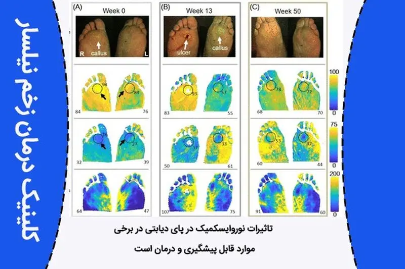 دیابتی قابل پیشگیری و درمان