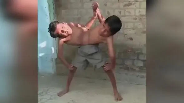 فیلم ناراحت کننده  از  2 برادر به هم چسبیده + خنده های تلخ جلوی دوربین