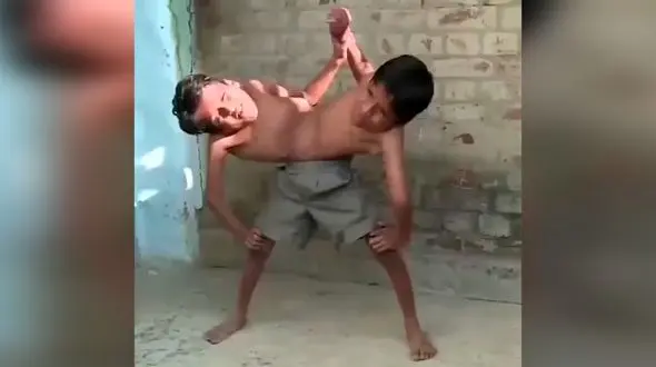 فیلم ناراحت کننده  از  2 برادر به هم چسبیده + خنده های تلخ جلوی دوربین