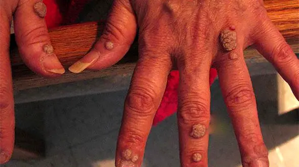 ابتلای سالانه ۱۰۰۰ تا ۲۰۰۰ نفر به سالک + راه های درمان