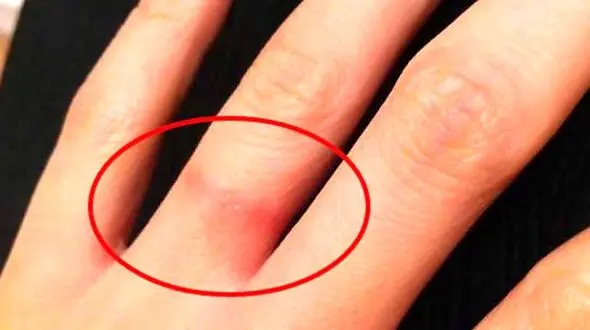 حساسیت به بدلیجات قابل درمان است؟