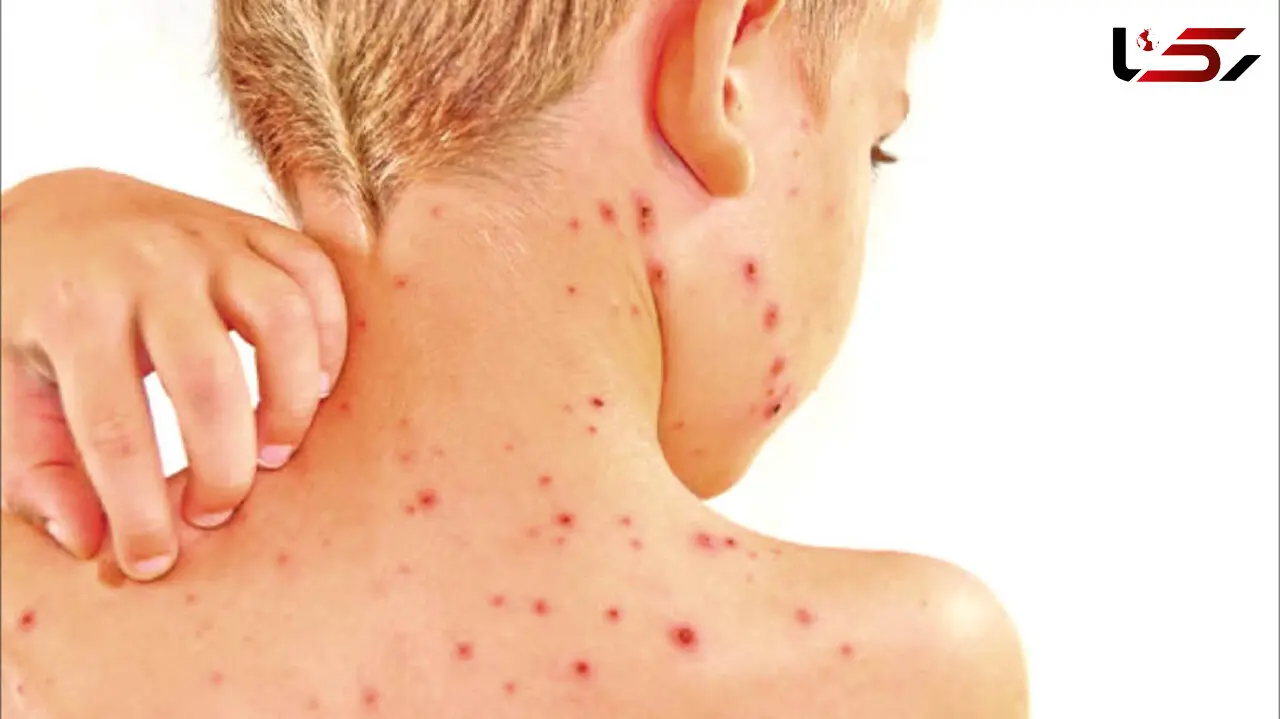 علائم اولیه آبله میمون در کودکان