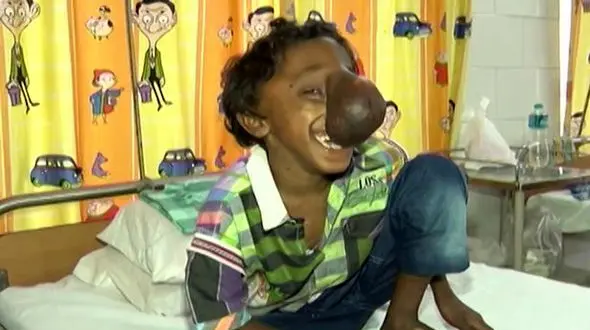 این پسر بچه شبیه فیل است+تصاویر عجیب