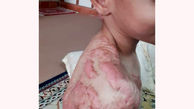 زنده زنده سوختن کودک 6 ساله اهوازی / یک زن فرشته شد + فیلم و عکس 