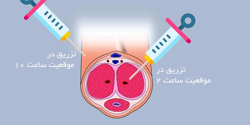 درمان نعوظ