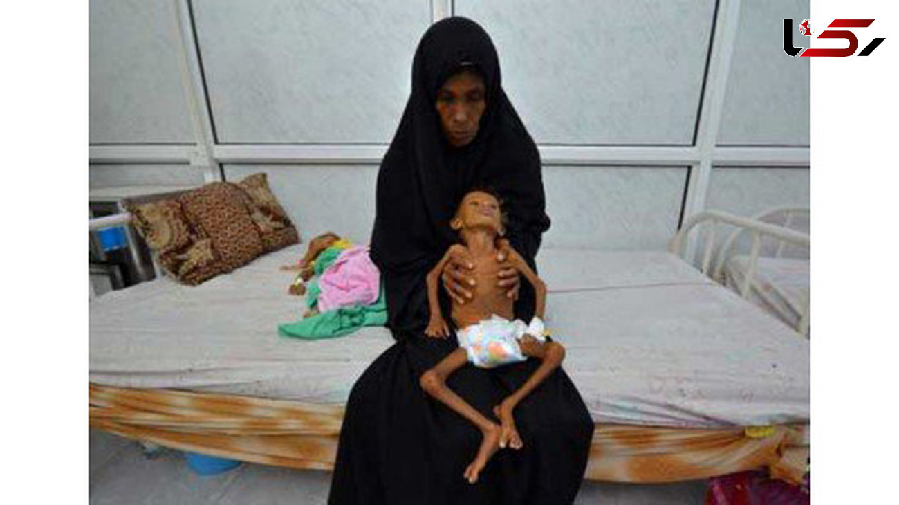 یونیسف: ۳۸۰ هزار کودک یمنی از سوء‌تغذیه شدید رنج می‌برند