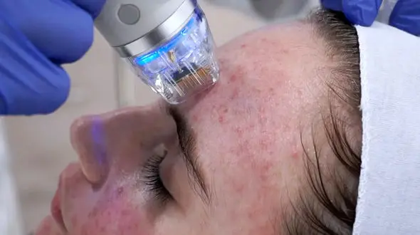 آر اف چیست؟