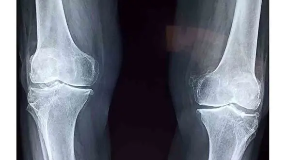 درمان آرتروز زانو با یک تزریق ساده