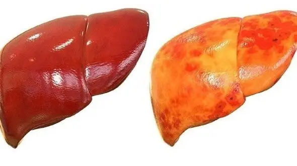 قاتلان کبد چرب چیست؟+ اینفوگرافی
