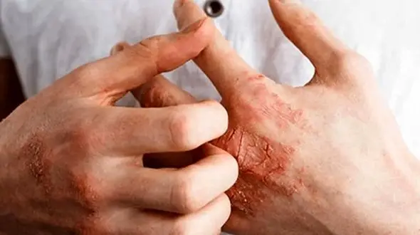 چطور خانه تکانی کنیم بدون اینکه دچار اگزما شویم؟