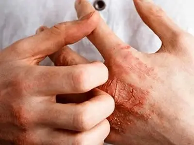 چطور خانه تکانی کنیم بدون اینکه دچار اگزما شویم؟