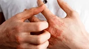 چطور خانه تکانی کنیم بدون اینکه دچار اگزما شویم؟