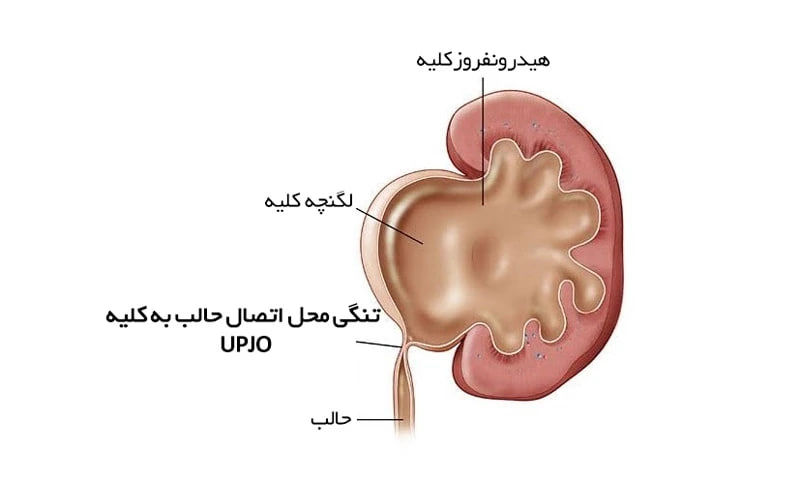 هیدرونفروز کلیه