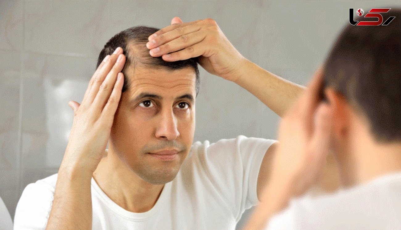 کمبود این ویتامین عامل اصلی ریزش مو است!