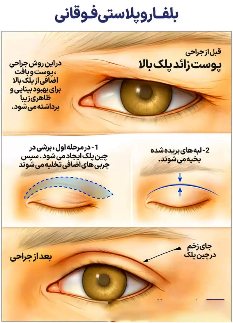 جراحی پلک