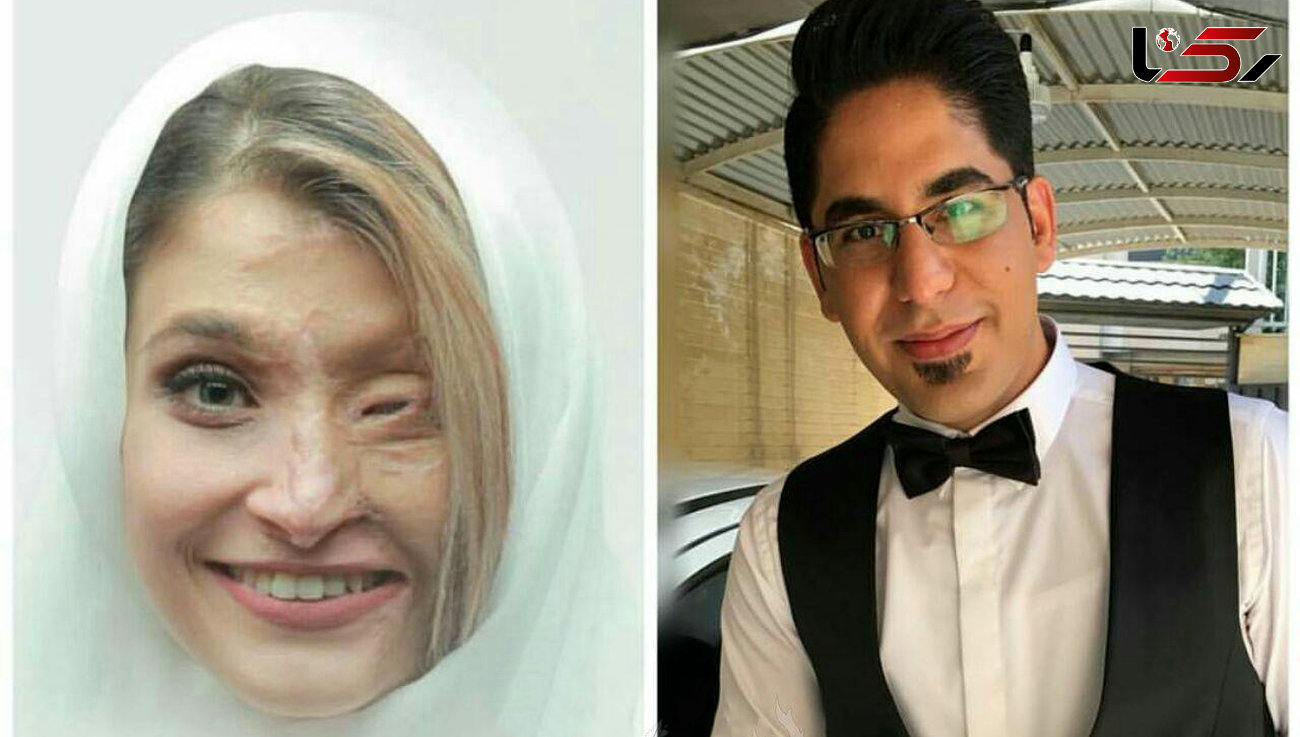 عکس داماد و عروسش که قربانی اسیدپاشی اصفهان بود / نصف صورت مرضیه سوخته بود