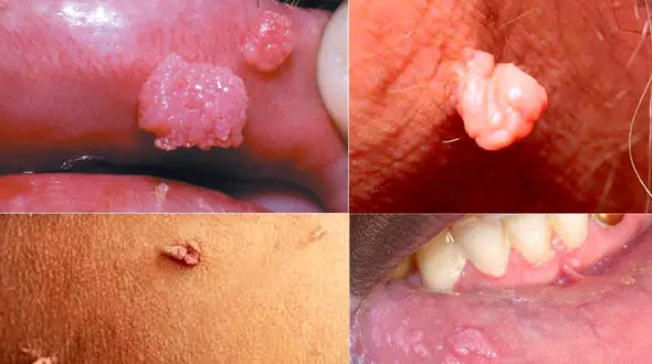 زگیل تناسلی چیست؟ + جدول روش های پیشگیری و درمان 