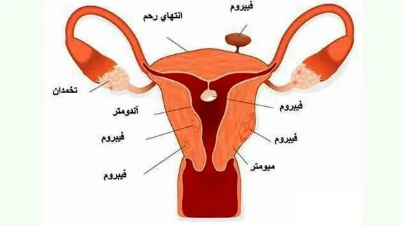 برای درمان فیبروم چه باید کرد؟