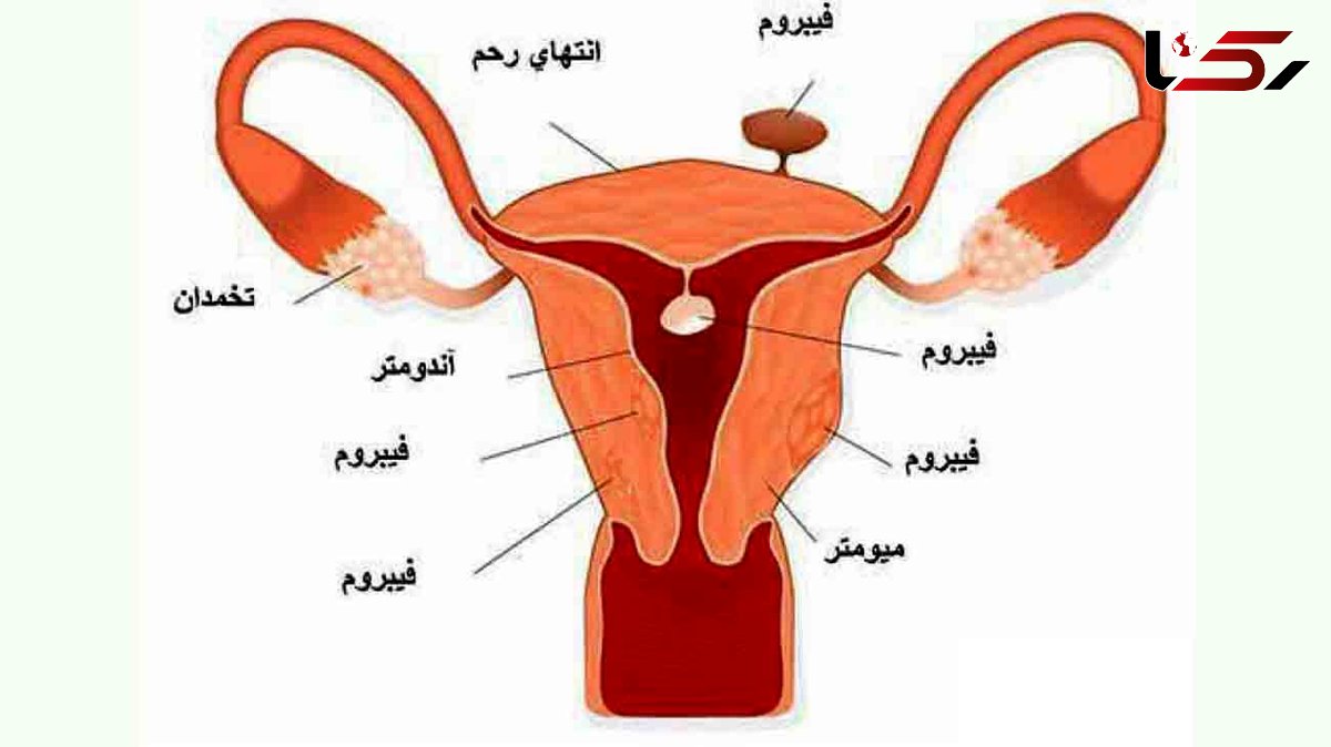 برای درمان فیبروم چه باید کرد؟