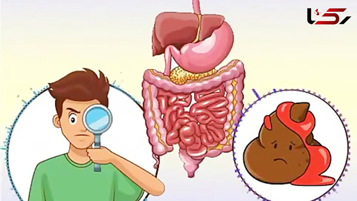 بررسی علل وجود خون در مدفوع / از تشخیص تا درمان