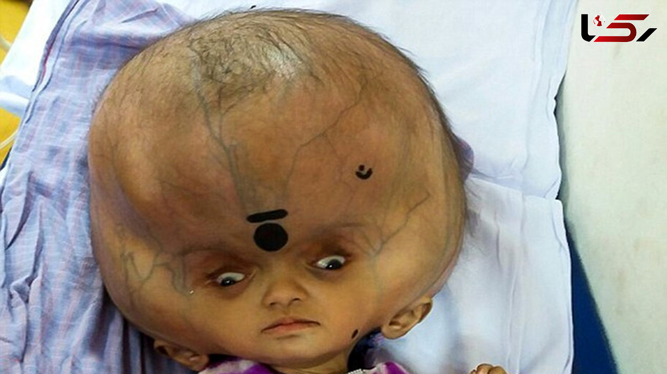 بزرگترین سر جهان جراحی شد/ قطر سر این کودک 7 ماهه یک متر شده بود!+تصاویر