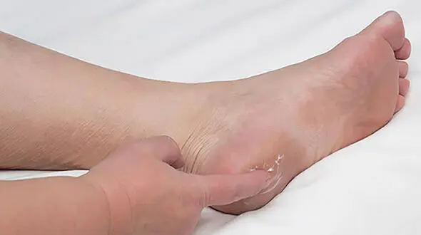 خار پاشنه چیست؟ + جدول درمان خانگی