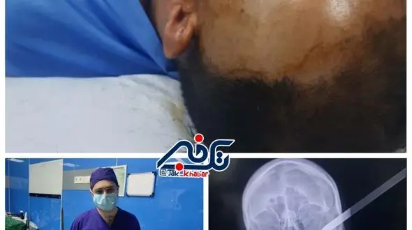  در آوردن سیخ کباب از گیجگاه یک جوان مشگین شهری!