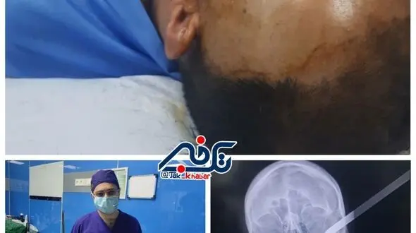  در آوردن سیخ کباب از گیجگاه یک جوان مشگین شهری!