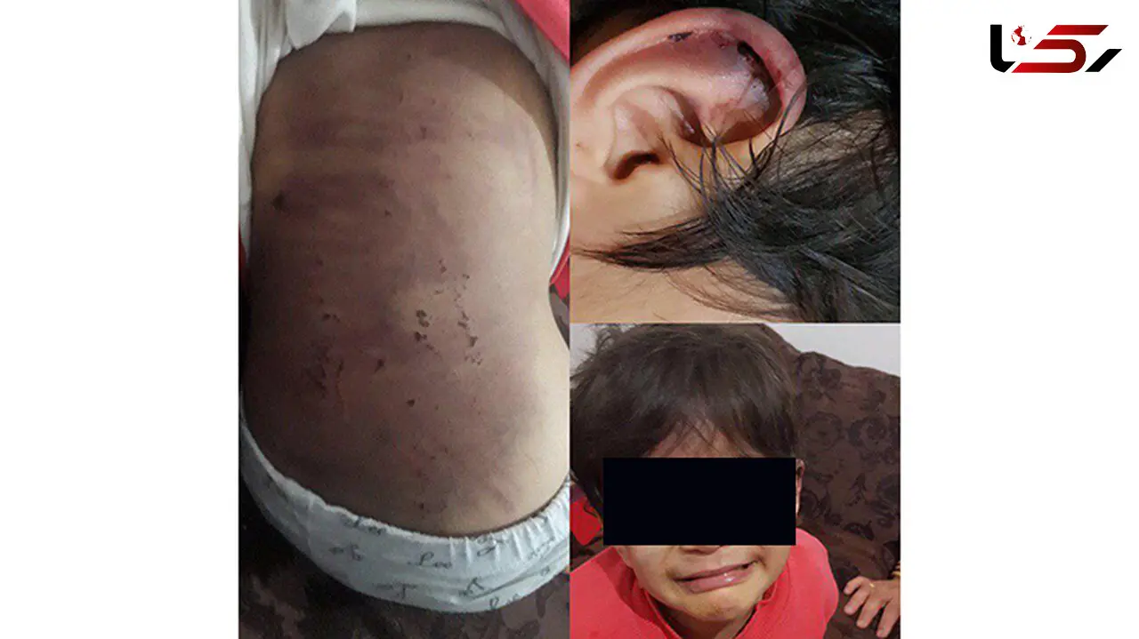 کودک آزارى در ارومیه توسط نامادر بى رحم+ عکس تکاندهنده
