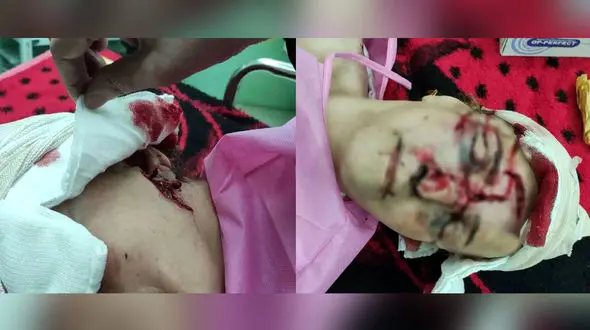 اولین عکس های دلخراش از زن پیرانشهری که هدف حمله خرس وحشی شد 