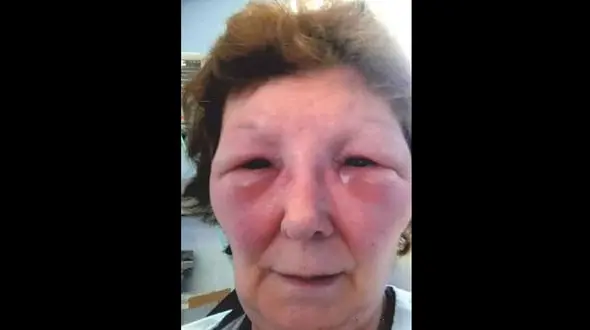 جراحی زیبایی از این زن هیولا ساخت ! + عکس / انگلیس