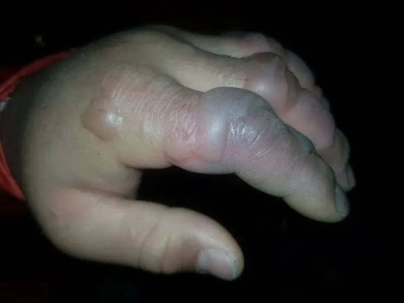 5 عکس وحشتناک از سرمازدگی یک کوهنورد در ارتفاعات کلکچال 