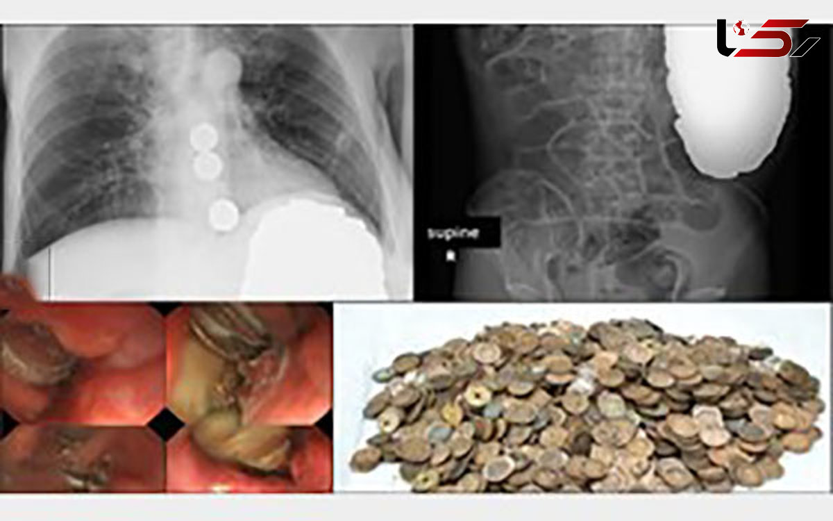 این مرد 1894 سکه را خورد! +عکس